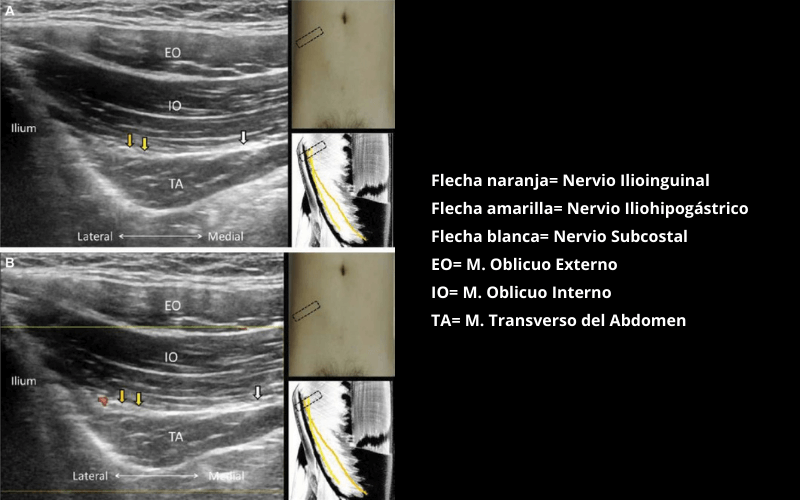 Nervio Ilioinguinal e Iliohipogastrico (1).png